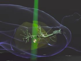 Radiation therapy